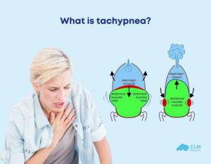 Tachypnea Symptoms Causes And Treatment CLM Sleep Tachypnea 2 300x234 